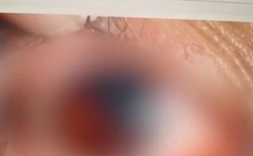 保温杯变定时炸弹?女子开盖被炸破眼球