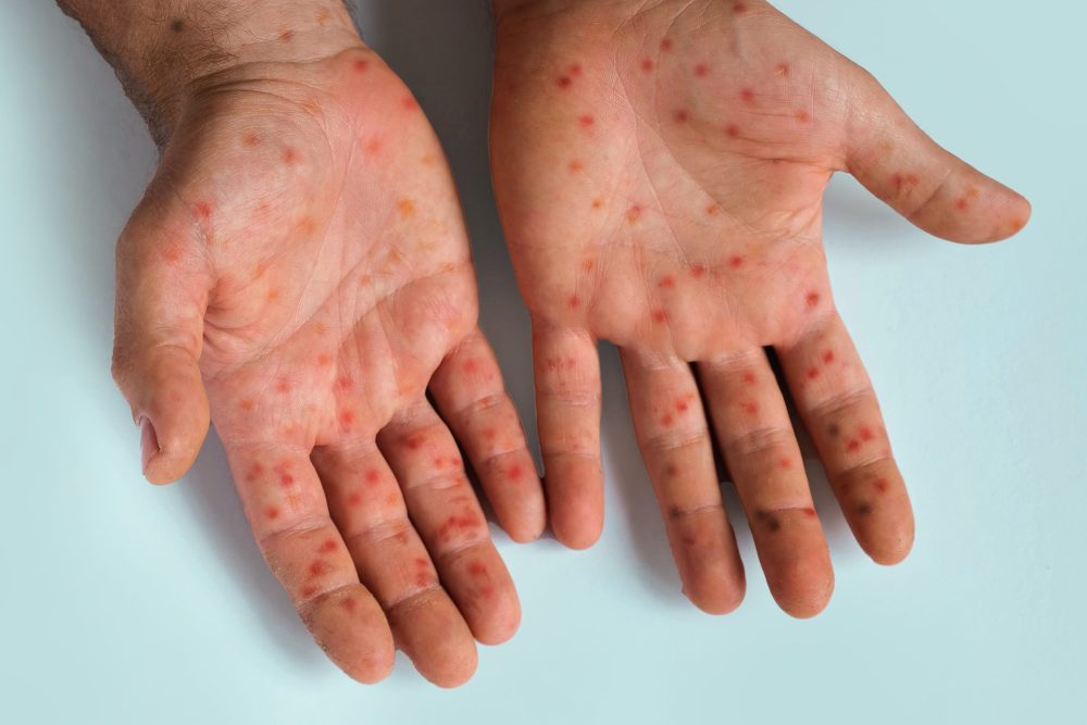 human-hands-with-painful-rash-red-spots-blisters-on-royalty-free-image-1723704944