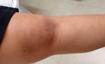 10岁男童遭围殴致伤 华小董事觉得像嬉闹非霸凌