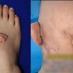 女工被机器扯走头皮 断耳寄养脚背5个月后归位