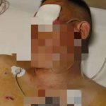 男子取款百万遭抢劫 搏斗20分钟一眼失明