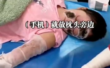 常常手机放床头充电 女子遭爆炸70%烧伤