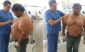 潜水员患“减压症”身体膨胀 医生也束手无策