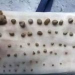 9岁童长期不喝水吃快餐 肾脏发现56颗结石