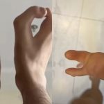 近亲结婚遗传风险惊人 男子天生“螃蟹手”罕见畸形