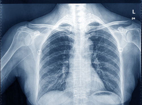 July_lungcancer_image-3