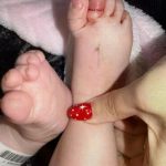 一根头发险毁一只脚趾 4月大女婴紧急手术保命