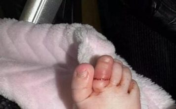 一根头发险毁一只脚趾 4月大女婴紧急手术保命