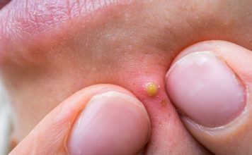 只是挤一颗痘痘 男子感染不治