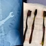 男子腹痛就医 2扳手7牙刷从胃中取出