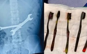 男子腹痛就医 2扳手7牙刷从胃中取出