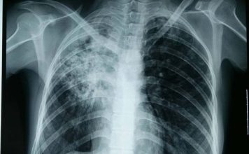 大马新增503宗肺结核 三地区占全国前三最多