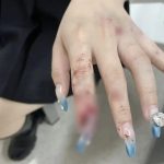 22岁女子骑车摔倒 食指连甲带肉被“连根拔起”