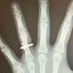 女子手腕受伤照X光 惊见骨头上“多一枚钻戒”