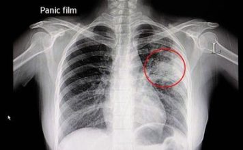 砂拉越肺结核病例破300宗 全马排名第三