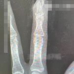 女子做美甲成“伤手利刃” 跌倒指骨骨折血染指尖