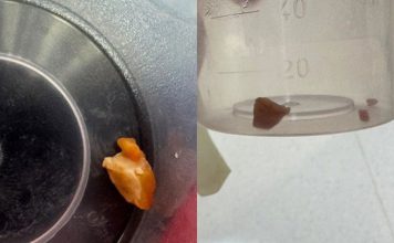 阿嬷一颗花生差点害死孙子 医生急手术救回塌陷肺部