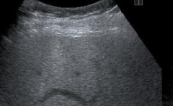 脂肪肝有救了 医生推荐“最强2蔬菜组合”