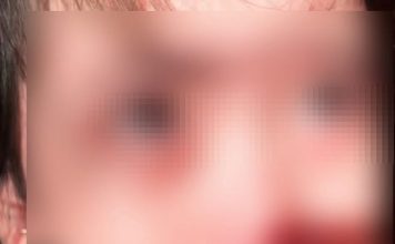 吸一口“舌头烫到颤抖” 3岁女童捂嘴痛哭急救