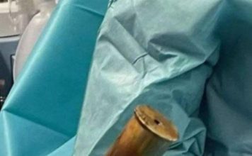 将巨型炮弹塞进肛门内 男子急送医吓坏医生