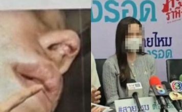 女网红花40万整形 结果肿成猪鼻感染凹洞