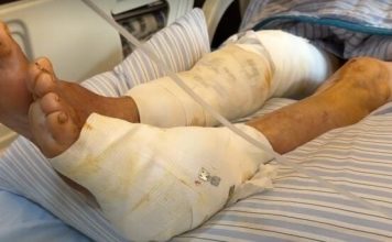 76岁老妇突遭犬群围攻 伤势深可见骨险些没命