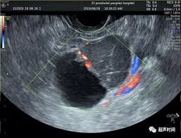 床上行为后腹痛出血 26岁女黄体破裂急手术