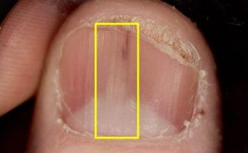 女子指甲长白线多年不愈 一查竟是长了肿瘤