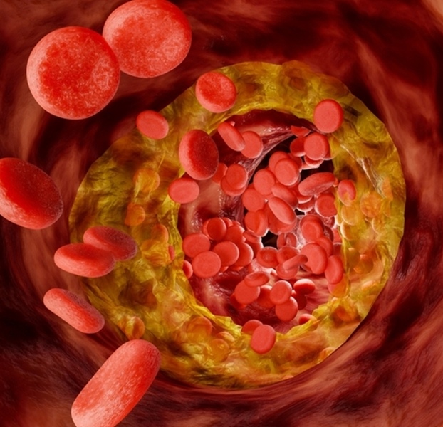 Hyperlipidemia,Or,Arteriosclerosis.,Blocked,Artery,Concept,And,Human,Blood,Vessel