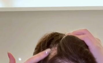 最强小三也撑不住 头顶大片脱发