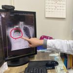 男子反复昏迷数月 医生一查体内竟藏巨瘤