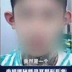 追求小脸代价惨重 女子做精灵耳后永久性面瘫