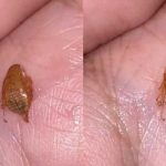 男子连续喉咙刺痛 最后咳出昆虫状物体