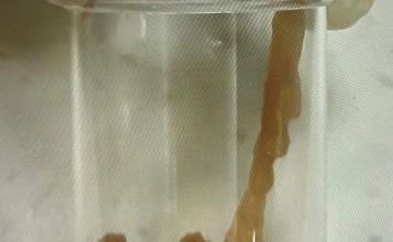 女童爱吃生鱼片 排便惊见白色长虫爬出