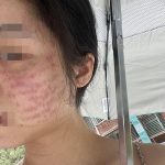 女子打“水光针”毁容 双颊留下排状疤痕