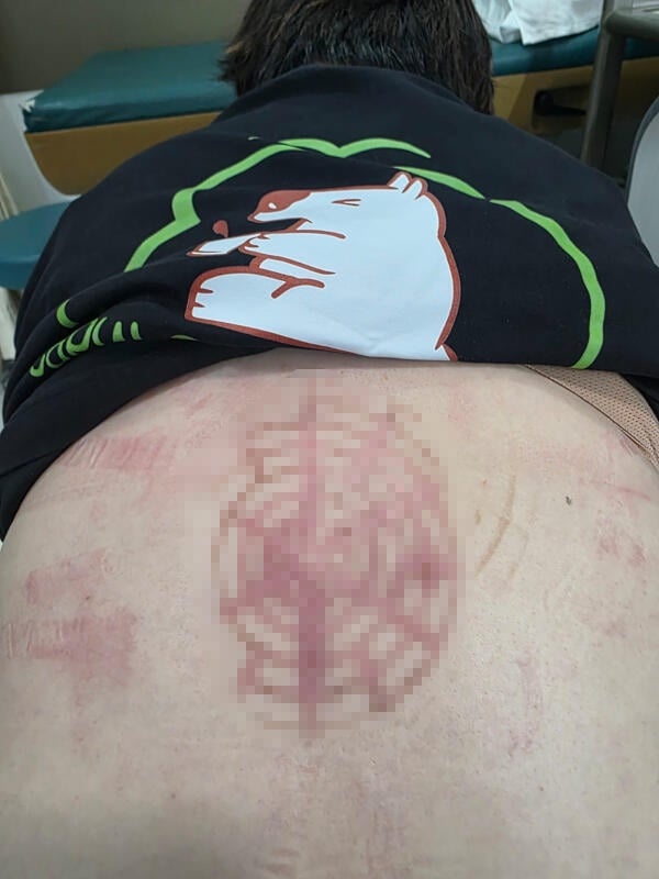 Second-degree-burns-260514-a1-no