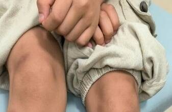 吃生菜包烤肉后出事?男童感染寄生虫全身瘀青