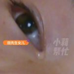 11岁女孩频繁呕吐 突然被确诊为肾衰竭