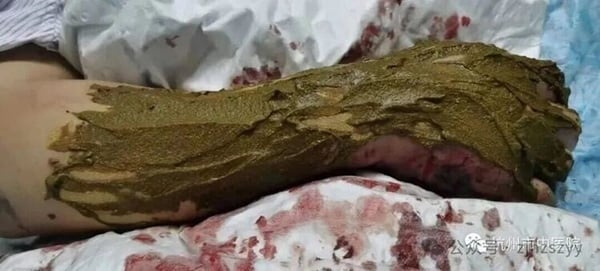 Hundred-pace-snake-bite-260623-a