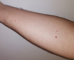250px-Angioma_cereza_en_brazo