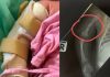 出生仅19天婴儿左臂骨折 华裔女控月子中心粗暴照护