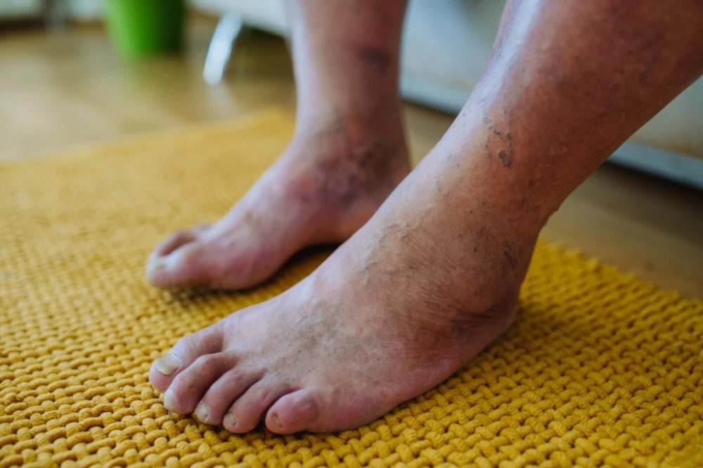 diabetic-foot-1-1024x683