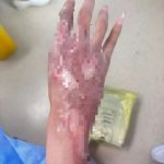 拍摄“火焰效果”操作失误 女子瞬间被窜火烧伤双手