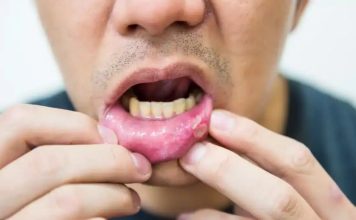 用嘴巴替女伴“服务” 男子隔天急问能否验HPV