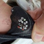 袜子藏14颗虫卵穿4小时 女子脱下发现竟已孵化