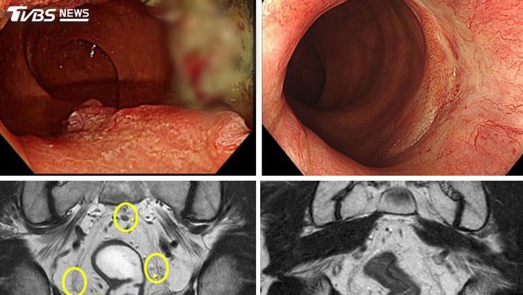 20260917-07-Rectal-Cancer-fn2609