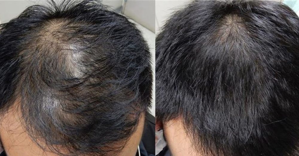 Baldness-fighting-ingredients-26