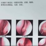 5岁塞进鼻孔的豌豆忘了取 女子18年后检查吓一跳