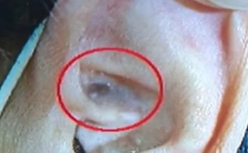 男子耳朵出现发黑症状 就医后确诊患大肠癌