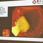 8旬翁吞下假牙拖2个月 卡进小肠憩室险酿并发症